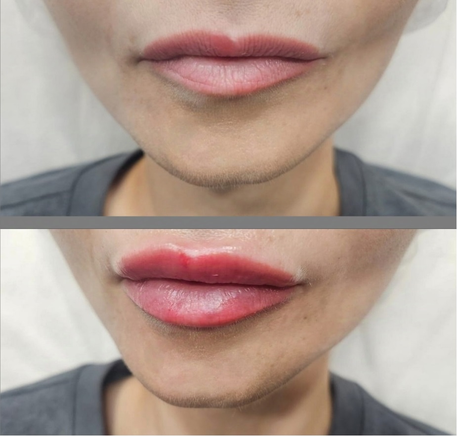 Контурная пластика губ
